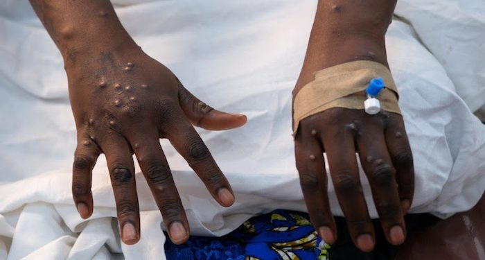 Ghana Confirms 21 New Mpox Cases, Total Infections Rise to 218 – GHS